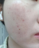 逆天了！施颜适水杨酸棉片， 见证油痘肌的美丽转变